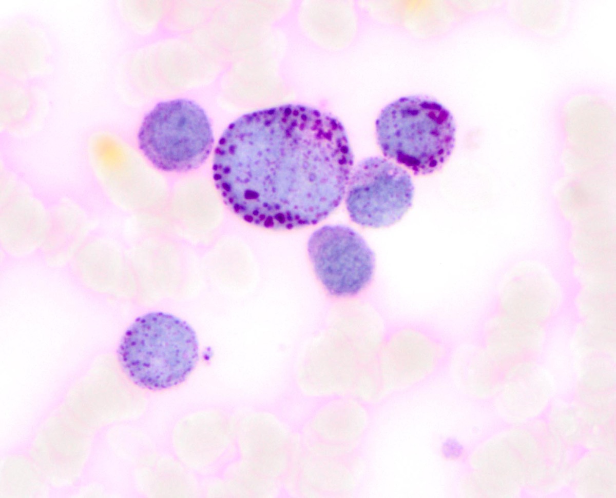 The cytoplasm of the erythroids shows strong globular staining with PAS (periodic acid-Schiff stain, 1000x)